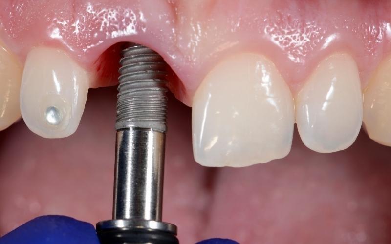 Công dụng của dịch vụ trồng răng implant tại nha khoa Sai Gon New Dental.