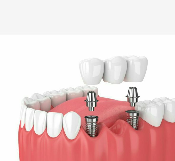 Bảng giá cấy implant tại nha khoa Sai Gon New Dental.