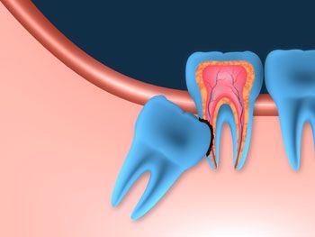 Nhổ răng khôn có cần thiết không?