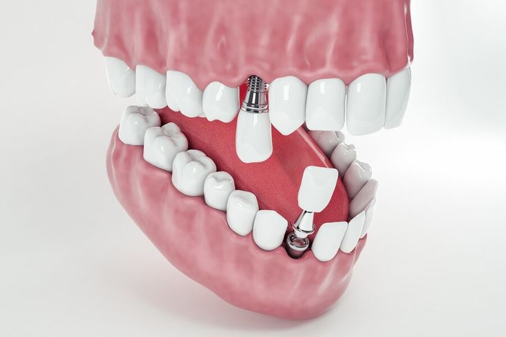 Dịch vụ trồng răng implant tại nha khoa Sai Gon New Dental.