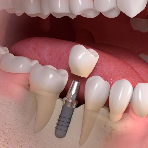 Dịch vụ trồng răng implant tại Nha khoa Saigonnewdental.