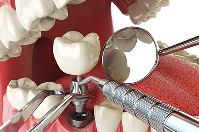 Dịch vụ trồng răng implant Đồng Hới