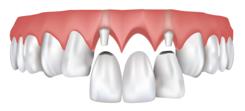 4 Trường hợp "không thể nào" cấy ghép IMPLANT Quảng Bình