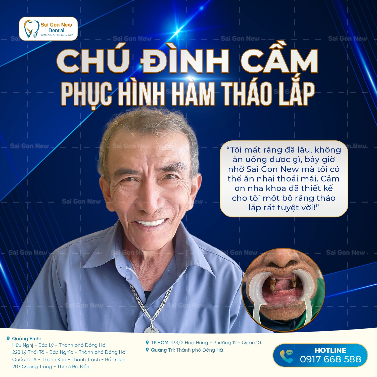 Làm Răng Giả Là Gì?