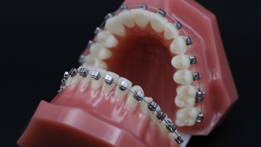 Dịch vụ niềng răng mắc cài cánh cam tại nha khoa Sai Gon New Dental.