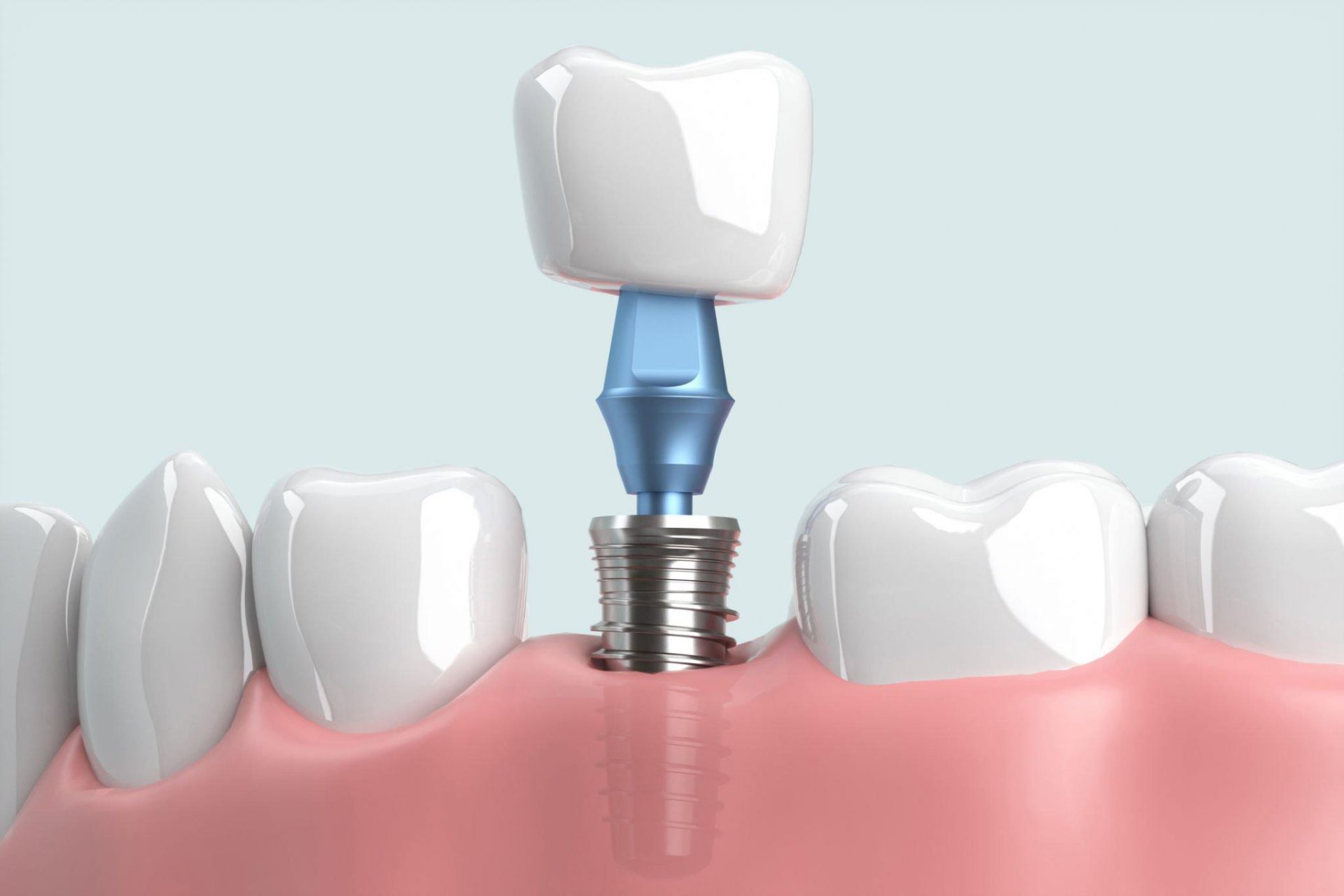 Cấy ghép răng implant tại nha khoa Sai Gon New Dental.