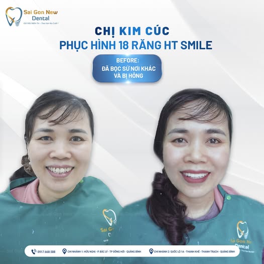 Bọc răng sứ thẩm mỹ