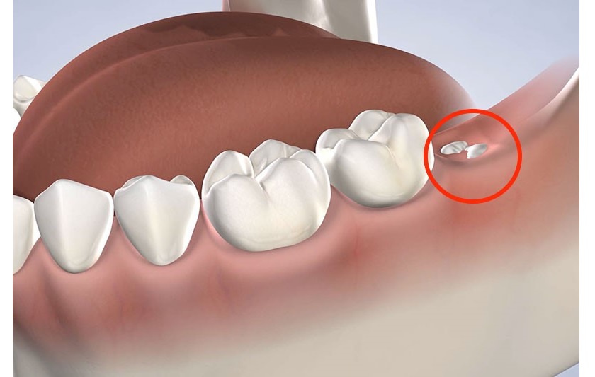 Một số cách để giảm sưng sau nhổ răng khôn.