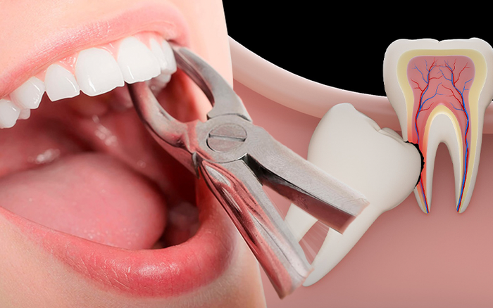 Nhổ răng khôn tại nha khoa Sai Gon New Dental Quảng Bình.