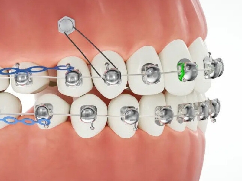 Mắc cài cánh cam giá bao nhiêu trên thị trường hiện nay?