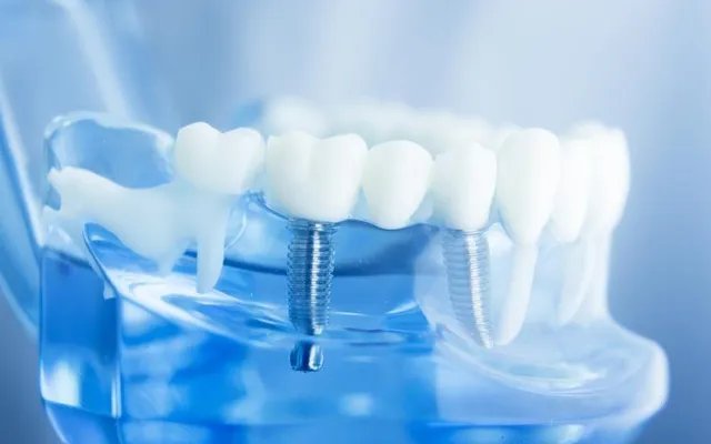 Quy trình cấy ghép răng implant tại nha khoa Sai Gon New Dental.