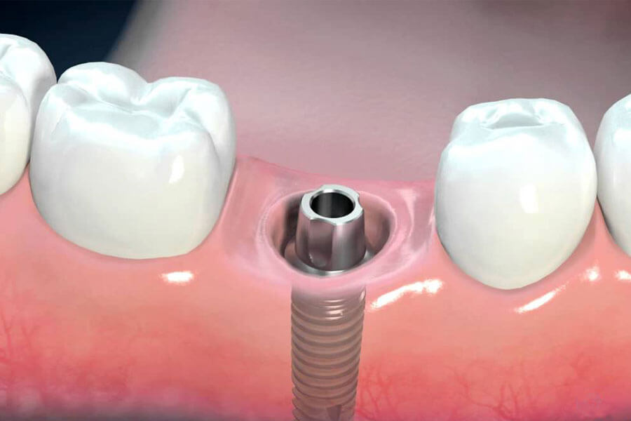 Trồng răng implant bao nhiêu tiền?