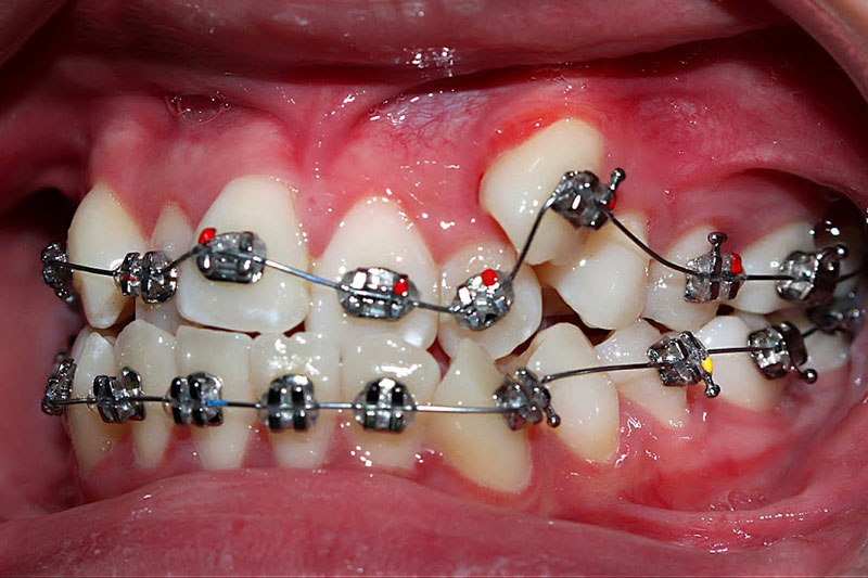 Niềng răng khểnh là cân thiết để bảo vệ sức khỏe răng miệng