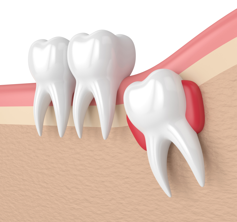 Những trường hợp không được nhổ răng khôn.