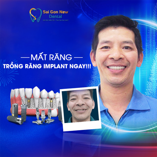 Trồng răng implant giá bao nhiêu? Bảng giá mới nhất 2024