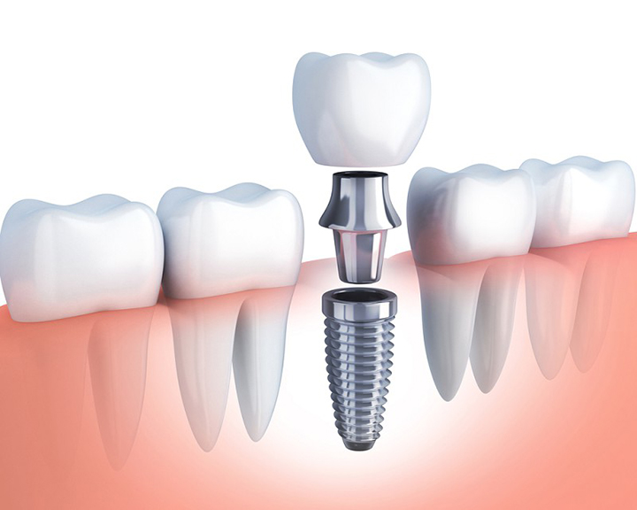 Gắn implant là gì?