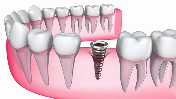 Dịch vụ trồng răng implant tại nha khoa Sai Gon New Dental.