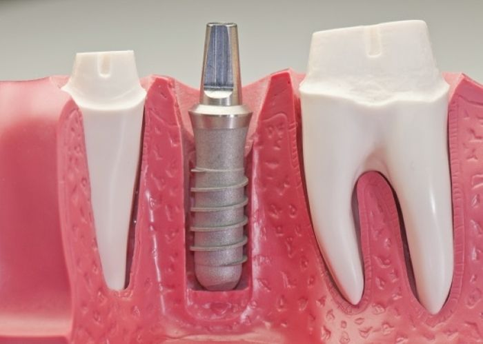 Bảng giá dịch vụ kỹ thuật cấy ghép Implant tại nha khoa Sai Gon New Dental.