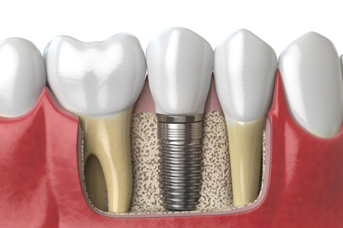 Lợi ích khi sử dụng dịch vụ kỹ thuật cấy ghép Implant chất lượng tại nha khoa Sai Gon New Dental.