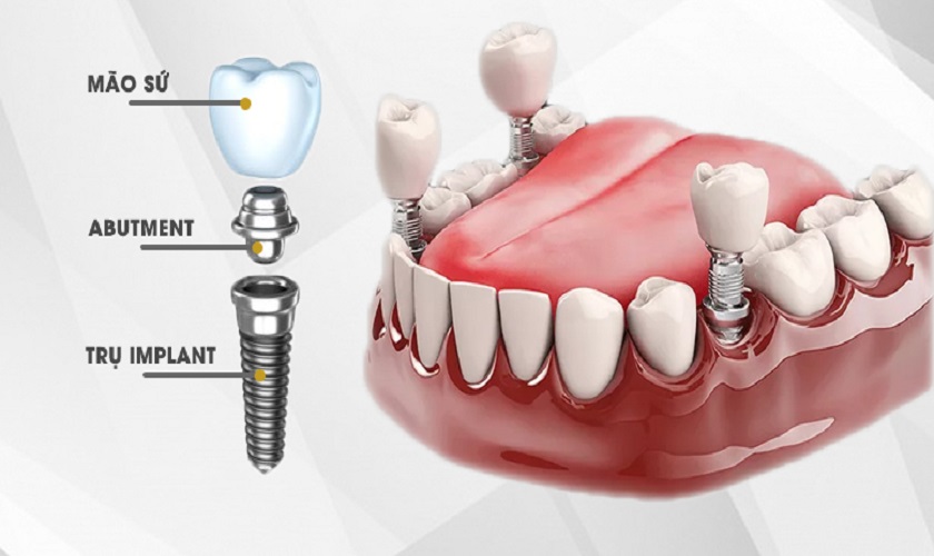 Quy Trình Cấy Ghép Implant Tiêu Chuẩn Như Thế Nào?