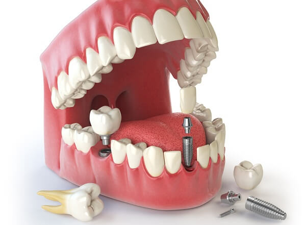 Thời gian cấy ghép implant tiêu chuẩn mất bao lâu?