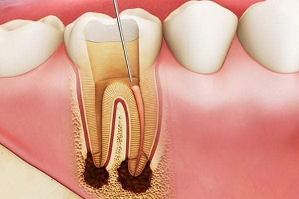 CÁC DẤU HIỆU NHẬN BIẾT CỦA BỆNH LÝ TUỶ RĂNG 