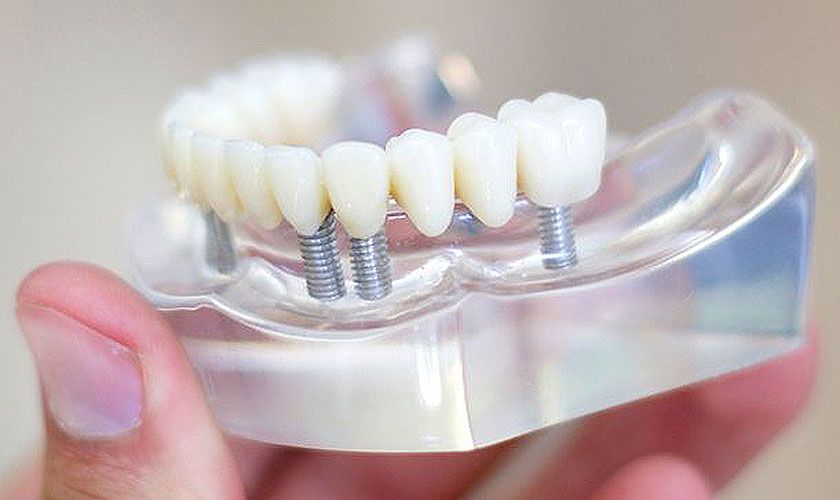 Kỹ thuật cấy ghép Implant Đồng Hới là gì?