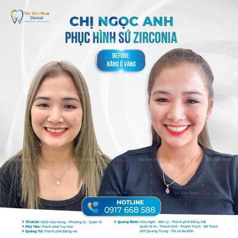 Bọc răng sứ thẩm mỹ quy trình gồm mấy bước?